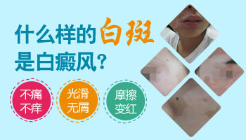 2岁男孩患上白癜风的概率有多大