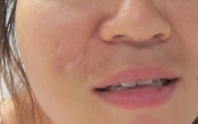 脸上出现小白斑是怎么回事