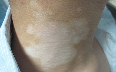 脖子手背胳膊大腿都有白癜风如何治疗好