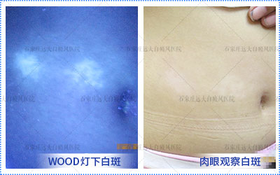 白癜风多长时间能显现出来