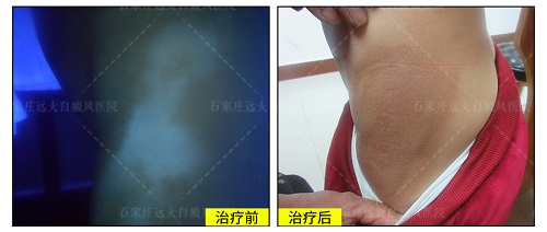 腋下有白癜风是什么原因 长白斑怎么治