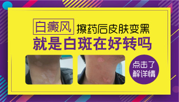 白癜风擦药膏越擦越白是什么情况