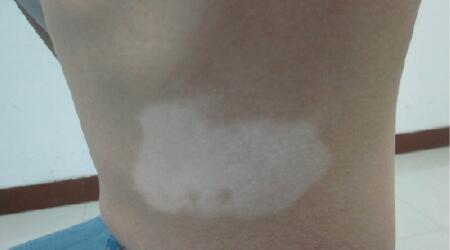 小腹下面一片白 皮肤变白是白癜风吗