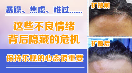 白癜风是什么原因引起的