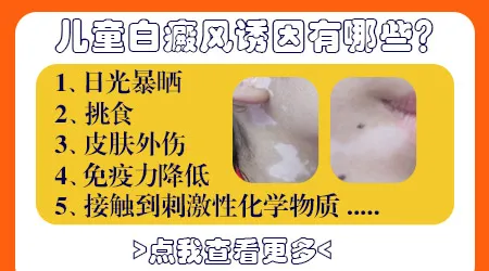 父母没有白癜风孩子为什么会长白斑