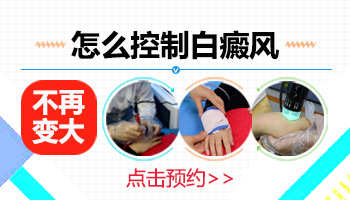 脸上发现白癜风能控制住吗