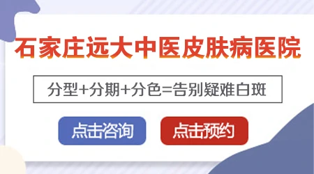 白癜风边界清晰是不是稳定期不会扩散