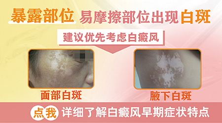 白斑能治好吗 什么样的白斑是白癜风