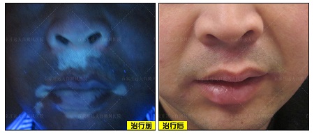 白癜风粘膜部位能做308激光吗