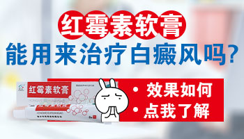 用红霉素软膏檫白癜风患处可不可以
