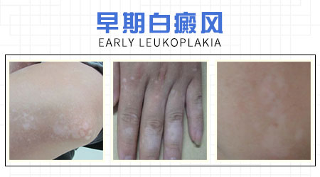 小孩腿上有块白的怎么回事