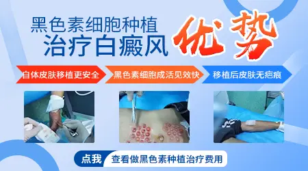 白癜风做黑色素种植效果好不好