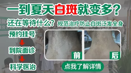 白癜风患者夏季方法措施
