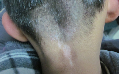 小孩脖子上有白斑图片