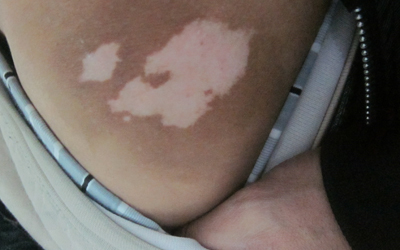 孩子大腿根部的白斑发现一年了还在变大