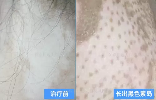 白斑中间出现色素岛多久才能复色