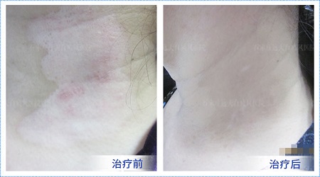 小孩胸部白斑是什么类型的白斑