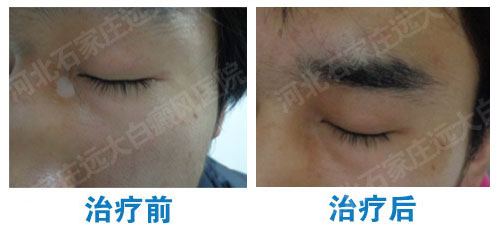 内眼角皮肤发白是怎么回事