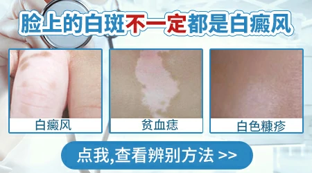 小孩子脸上有白斑是怎么回事