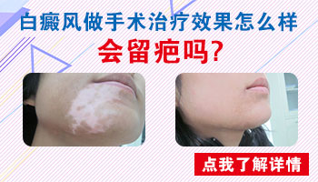 白癜风植皮手术需要住院吗