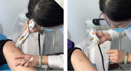 早期白癜风能不能根治 早期白斑的治疗方法