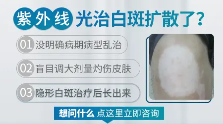 为什么儿童照光后白癜风会扩散