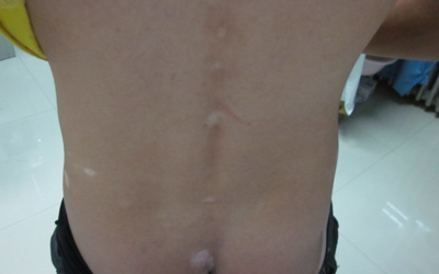 小孩腰间好几块白斑是怎么了