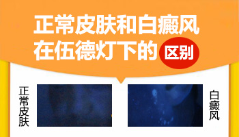 身上长白斑做伍德灯多久能出结果