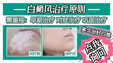 白癜风怎么治疗才会有效果