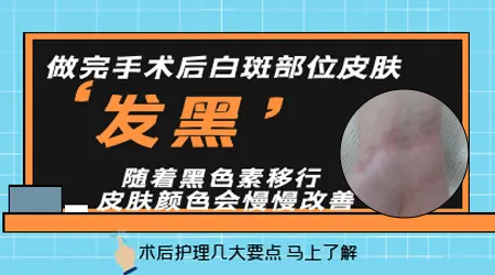 白癜风移植后的色差怎么消除