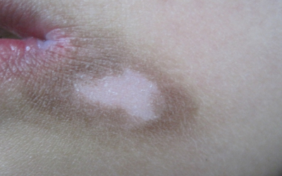 6岁小孩嘴唇上长白斑图片