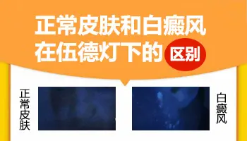 伍德灯检测白斑是检查全身吗