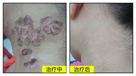脖子白癜风治疗过没扩散还用治吗