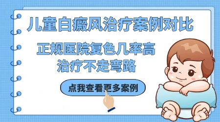 衡水哪里能治小孩白斑