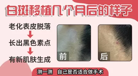 手术种植白癜风多久能恢复