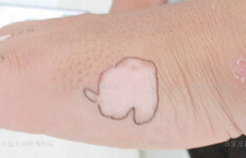 早期手部白癜风图片 手指白斑怎么治