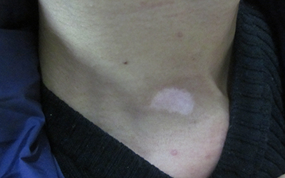 后脖上的白斑有瓶盖大小是什么