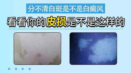 脖子上冒出白点会是早期白癜风吗