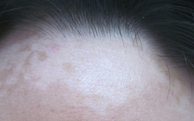 额头发际线白癜风治疗方法