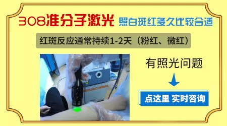 嘴唇上长白癜风能冶好吗