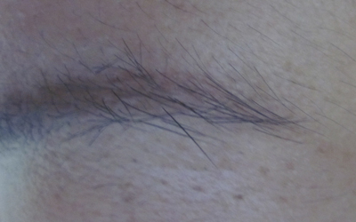 白癜风眉毛变白早期图片