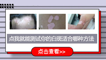 邯郸白癜风医院收费贵不贵