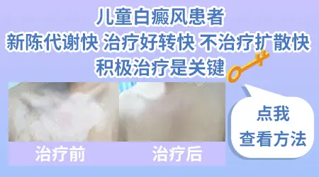 儿童早期白癜风能不能治好