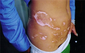 15岁孩子肚子上有白斑像是白癜风