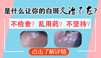 白癜风一直在做308治疗效果不好