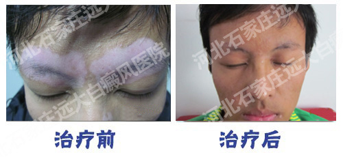 脸部白癜风植皮手术图片