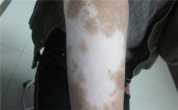 小孩子白癜风症状图片