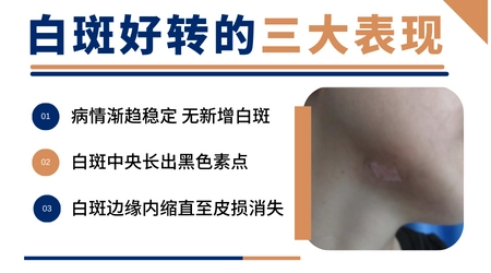 进展期白癜风吃什么药控制白斑扩散