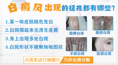 白癜风前兆是什么样的