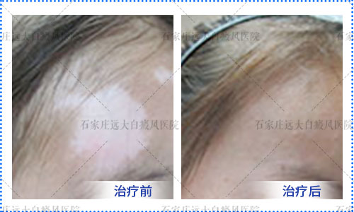 10岁儿童额头上方发现白癜风怎么治疗